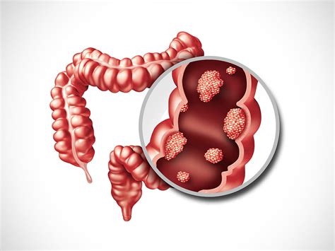 Colorectal cancer is the third most common cancer diagnosed in both men and women in the united states. Colon Cancer Prevention | Associated Gastroenterology in ...