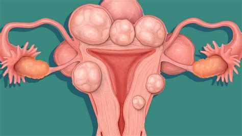 Biasanya ini dialami oleh para remaja yang baru pertamakali menstruasi. 6 Penyebab Darah Mens Berwarna Gelap-Hitam. Normal Atau ...