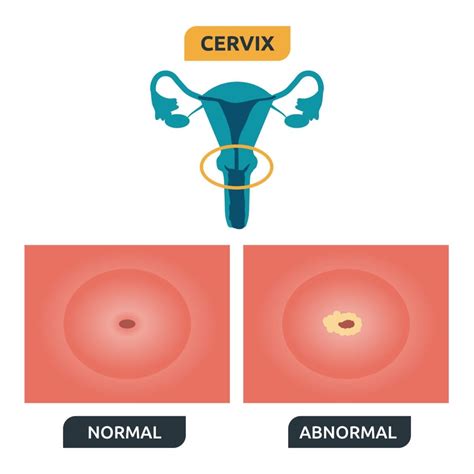 Smoking and having a weakened immune system increase the chance that an hpv infection will not go away on its own and will develop into a precancerous condition of the cervix. Bmi Calculator Que Es En Español - Aljism Blog