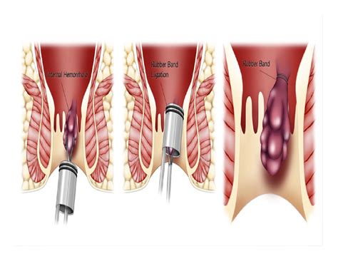 They are classified as grade iv hemorrhoids. Hemorrhoids symptoms, hemroids treatment, internal ...