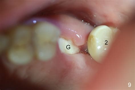 The recovery period for gums to heal varies from individual to individual and also as per the procedure done to extract the tooth. Immediate Implant or bone powder to prevent bone shrinkage ...