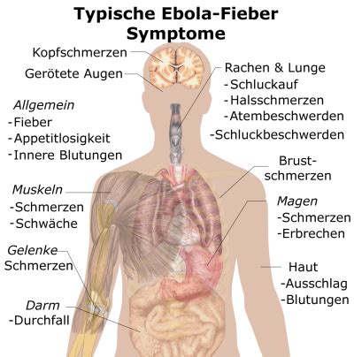 Eine verdachtsdiagnose auf ein hämorrhagisches fieber ergibt sich aus dem plötzlichen auftreten der beschriebenen. Ebola - Ursachen, Symptome, Behandlung, Komplikation ...