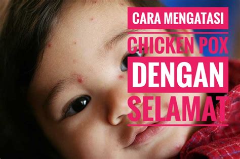 Hal ini merupakan perubahan besar dalam pola kehidupannya , pada sebagian besar anak. CARA MENGATASI CHICKEN POX DENGAN SELAMAT - CIK WATI SHOPP ...