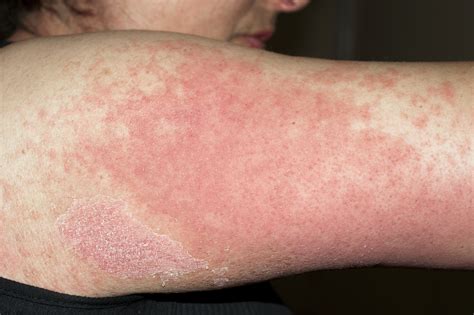 Examples of medicines that have shown to trigger rashes include diuretics, anticonvulsants (phenytoin), drugs used in chemotherapy and. Can u get a rash from antibiotics - Health