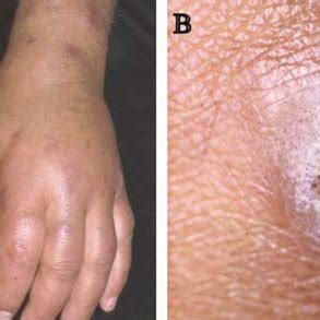 Una alteración de ese equilibro puede provocar una enfermedad de la piel. Mucormycosis diagnosis. A smear taken from skin lesion ...