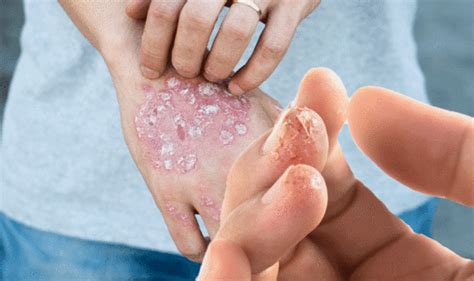 This can be very painful and lead to complications if not properly treated. Eczema: Have you experienced these symptoms? You may have ...