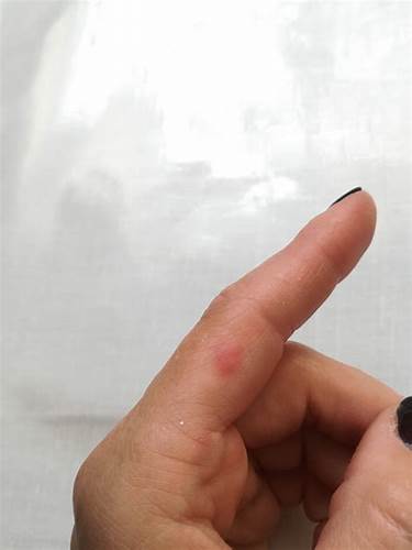 Диета при экссудативной эритеме Лечение и профилактика многоформной экссудативной эритемы Наталия Лечение и профилактика многоформной экссудативной эритемы Наталия Диета при экссудативной эритеме