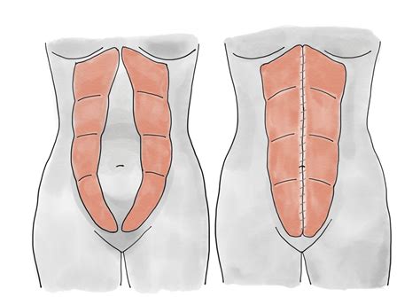 There are no right or wrong answers. Ratgeber: Rectusdiastase bei Müttern - MamaWORKOUT