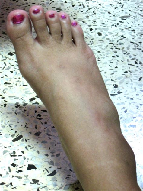 Retinacula (retinaculum singular) are bands of connective tissue which surround tendons and hold them in place. Pain In Ankle Bone - INNER ANKLE PAIN