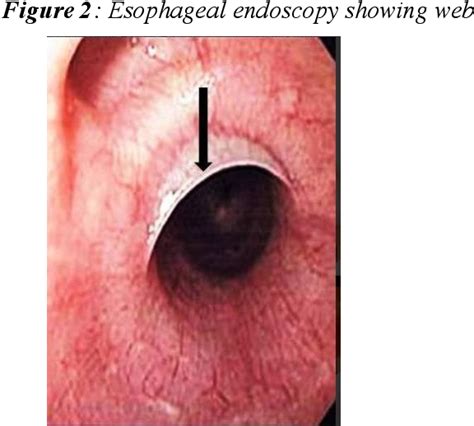 Later swallowing becomes painful as surrounding structures are. Figure 1 from Revisiting Plummer Vinson Syndrome : a ...