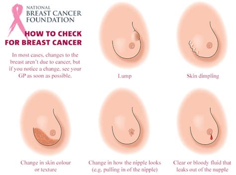 Belum tentu setiap benjolan di payudara adalah kanker (baca artikel sebelumnya tentang fibrokista), pada kenyataannya, sebagian besar hanya tumor jinak. Pemeriksaan Sendiri Payudara, Kesan Kanser Payudara Wanita ...