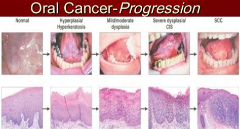 Mouth cancer is in the top five malignant diseases in the world. The Warning Signs & Symptoms of Mouth Cancer | Emergency ...