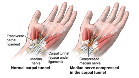 Carpal tunnel syndrome, the term that includes the various collections of symptoms that result from median nerve entrapment at the wrist, is much more common in women than men, by at least a 3:1 ratio. Natural Remedies for Carpal Tunnel Syndrome | South Austin ...
