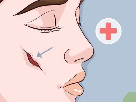 You needn't worry about the vinegar smell. 3 Simple Ways to Heal Facial Skin Fast - wikiHow