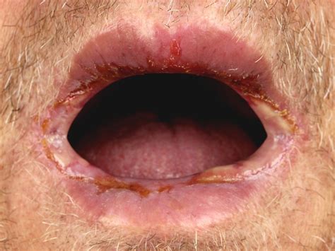 Graft versus host disease
