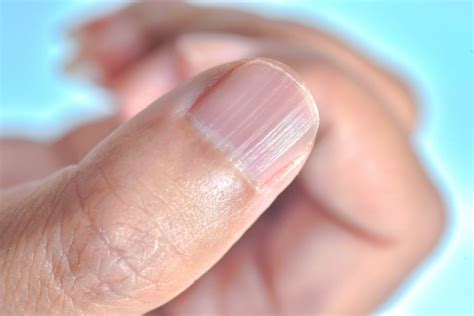 The ridges in nails are the lines running. Unhas onduladas: o que são, causas e tratamento - Escola ...