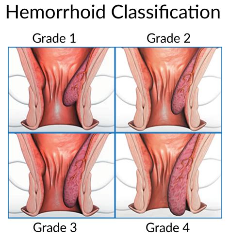 The symptoms of hemorrhoids (also called piles) and bowel cancer can be quite similar but do not have the same fatal results. Rectal Bleeding and Bleeding from the Rectum - Causes and ...