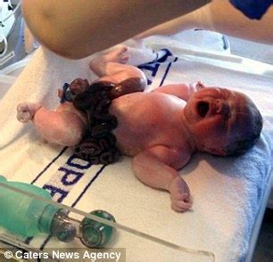The amazing true stories of how babies are made. Baby Born With Intestines Outside His Body (pics) - Health ...