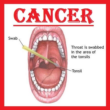 Tingling in the feet is a very common symptom and usually does not indicate a serious problem, says william buxton, m.d., neurologist and director of however, if you're still tingling after you untwist your legs, the feeling persists for a long time, or is accompanied by other symptoms like balance problems. What does throat cancer do