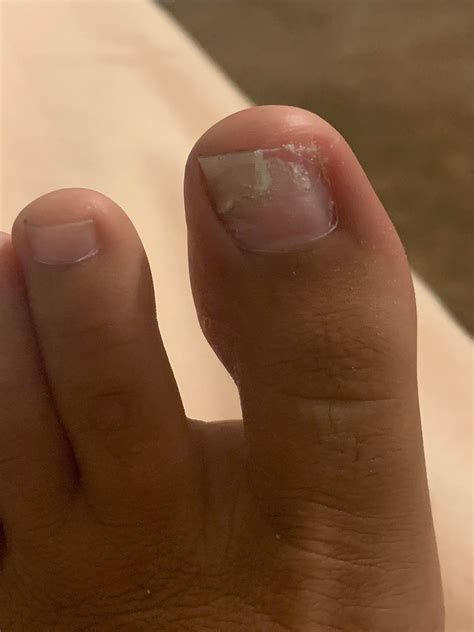 My toe is peeling : mildlyinteresting