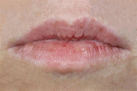 Ketika terjadi perubahan hormon pada masa remaja atau puber namun begitu bintik putih di bibir akibat fordyce spots ini tidak menular dan berbahaya. Cara Menghilangkan Putih Putih Di Pinggir Bibir ...
