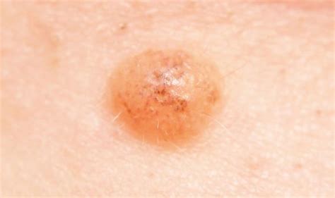 This skin cancer often develops on the head or neck and looks like a shiny, raised, and round growth. Skin cancer: Does your mole look like this? Pictures ...