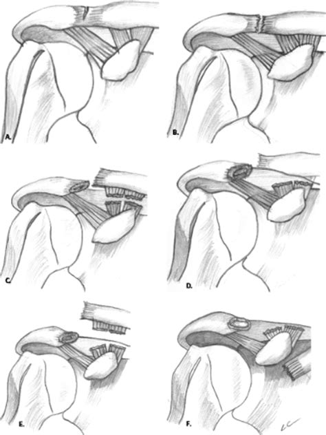 Although most people think of the shoulder as a single joint between the upper arm bone (humerus) and the torso, the shoulder actually has several smaller joints outside the arm bone's socket. Miscellaneous Conditions of the Shoulder | Radiology Key