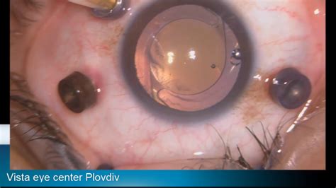 The term pseudophakia refers to having an artificial lens implanted after the natural eye lens has during cataract surgery the natural cloudy lens is replaced by an pseudophakia intraocular lens (iol). Pseudophakic retinal detachment Lukan Mishev Live Stream ...