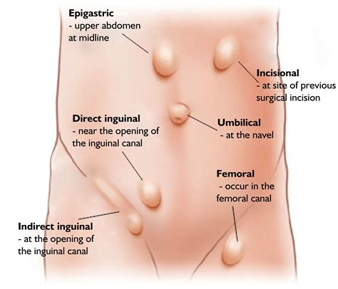 Complications of congenital diaphragmatic hernia. Inguinal Hernia Female Pictures - PictureMeta