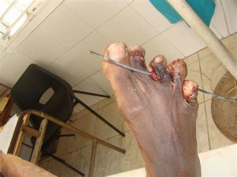 The forensic necropsy is described, including gunshot wound. Gunshot Wounds through the Toes | Forensic Pathology Online