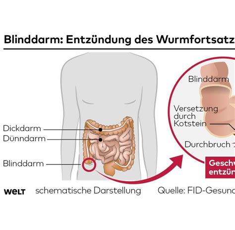 Eine blinddarmentzündung zu erkennen, ist nicht leicht. Appendix: Ist der Blinddarm wichtig oder kann er weg? - WELT