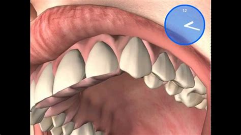 Vom fachzahnarzt für kieferorthopädie geplant, individuell im eigenen 3d labor gefertigt! Was sind Aligner - unsichtbare Zahnspange - YouTube