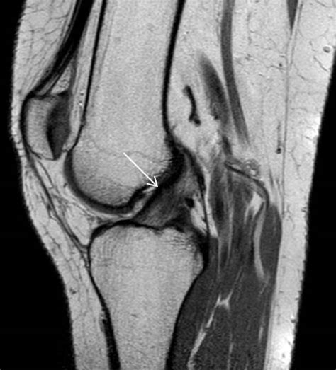 Indirect signs might be a typical meniscal or cartilage lesion, or a spontaneous anterior drawer. EPOS™ - C-0026