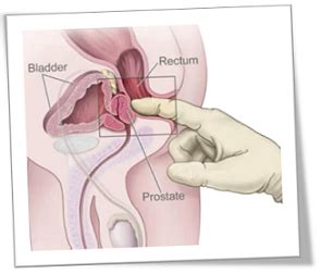 How do we know they're the hottest? Self Prostate Massage | Prostate Health Center