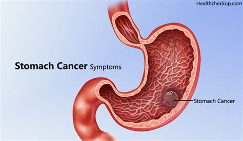 Some of the most common symptoms of advanced stomach cancer are: Gastric cancer early symptoms - Hpv virus and throat ...