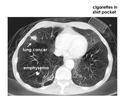 Various modalities have been used in the treatment of mpm. Mesothelioma Pet Scan