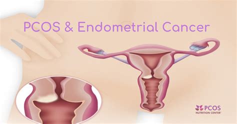 Stay informed, educate patients, be alert for risk factors, encourage screening, and treat them with compassionate care. PCOS and Endometrial Cancer: What Women Need to Know ...