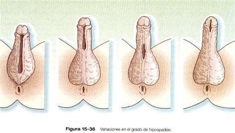 Hipospadia mediopeneana hipospadia subcoronal hipospadia perineal. Hipospadia y Epispadia - Urología Médica Monterrey