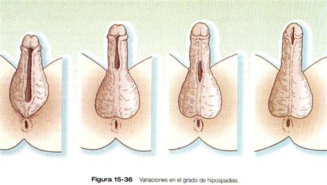 Hipospadia mediopeneana hipospadia subcoronal hipospadia perineal. Hipospadia y Epispadia - Urología Médica Monterrey