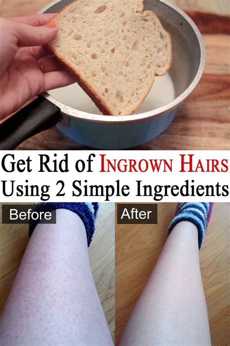 The infection can be caused by either bacteria or fungus. Get Rid of Ingrown Hairs Using 2 Simple Ingredients ...