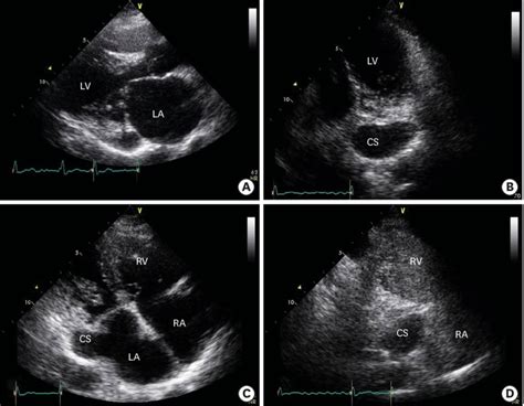 Related online courses on physioplus. Transthoracic echocardiography revealed mitral stenosis ...