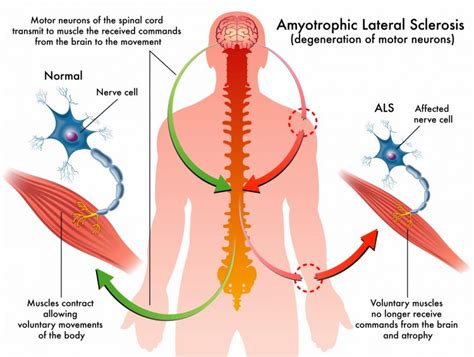 Download ALS: What Is Lou Gehrig's Disease? - University Health News