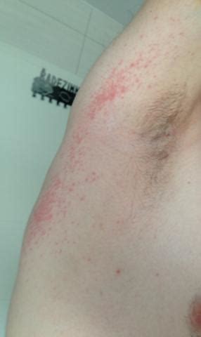 Хронический гепатит в и d. Ausschlag und Pickel, ein Anzeichen für eine HIV Infektion ...