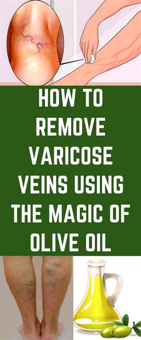 Now, your legs feel tired. HOW TO REMOVE VARICOSE VEINS USING THE MAGIC OF OLIVE OIL ...