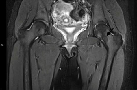 Coronal MRI T2WI image with fat saturation showing absence ...