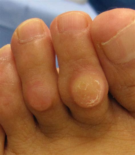 In the most basic terms, when your skin is subject to more friction than normal, the dead skin cells create a thick layer. Why do corns and calluses reoccur? | The Podiatry Practice