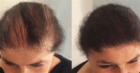 Voici la solution pour vite l'obtenir ! 3 ingrédients seulement, remèdes magique pousse les cheveux ! ~ Sport et Santé