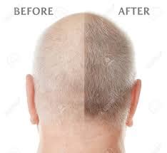 Laser Hair Transplantation - Regrowth. Your Source Of Hair ...