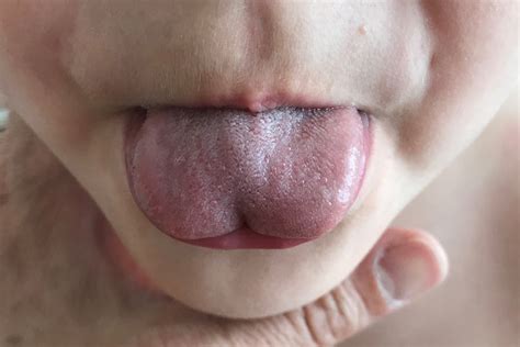Can Facebook tell you if your baby has a tongue-tie? - News - Illinois ...