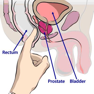 It remains the key diagnostic test and directs the therapeutic management of cancer of the lower and middle. Prostate Cancer - Symptoms and Treatment